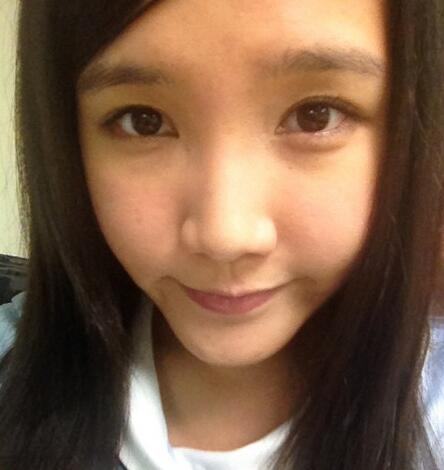 鄭州梨花雨整形美容醫(yī)院埋線雙眼皮整形案例分享