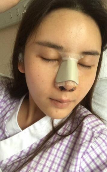剛做完肋軟骨隆鼻的圖片
