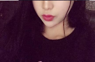 蔣正華醫(yī)生玻尿酸豐唇效果 蔣正華醫(yī)生玻尿酸豐唇效果