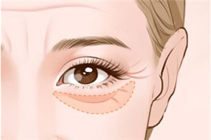 商丘冰薇醫(yī)療美容診所激光祛眼袋