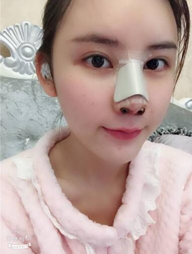 做完肋軟骨隆鼻恢復(fù)中
