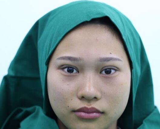 師麗麗雙眼皮案例分享 師麗麗雙眼皮案例分享