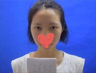 杜園園開外眼角案例效果對比圖 杜園園開外眼角案例效果對比圖