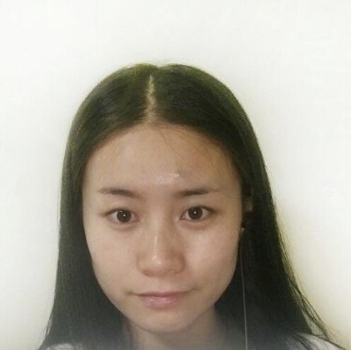 長沙愛思特整形醫(yī)生楊千里雙眼皮修復案例效果對比圖