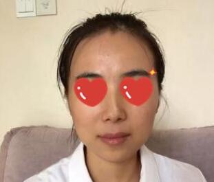 熊師玻尿酸隆下巴案例分享 熊師玻尿酸隆下巴案例分享