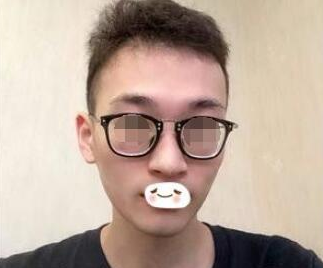 安徽醫(yī)科大學第二附屬醫(yī)院整形美容中心謝娟醫(yī)生做彩光嫩膚怎么樣，案例分享