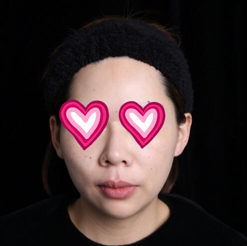 西安儷人醫(yī)院整形醫(yī)生蘇鵬做隆鼻技術(shù)怎么樣？附蘇鵬醫(yī)生隆鼻案例