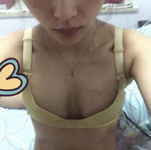 廣州駐顏光醫(yī)療美容診所整形專家劉培做復(fù)合隆胸技術(shù)怎么樣？附案例