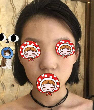北京京韓醫(yī)療美容診所做硅膠隆鼻效果怎么樣？北京京韓醫(yī)療硅膠隆鼻案例