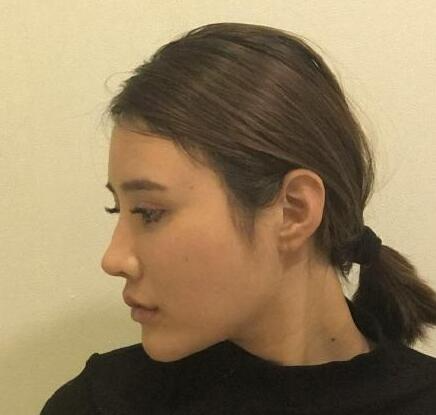 上海首爾麗格整形醫(yī)生樸興植做下頜角整形怎么樣？