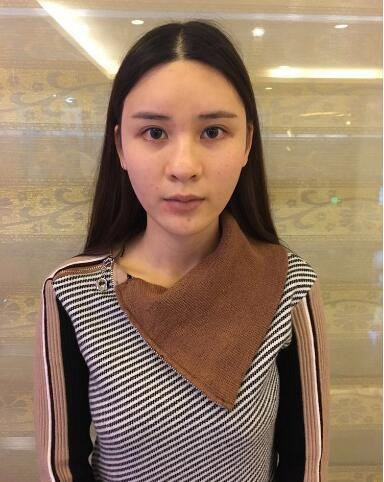 北京藝星整形專家郭峰做假體隆鼻修復怎么樣？郭峰假體隆鼻修復案例