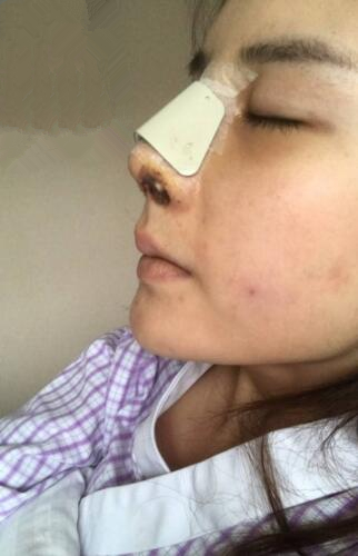 手術(shù)結(jié)束后 手術(shù)結(jié)束后