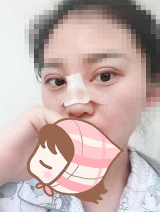 北京延世醫(yī)療整形專家周宜國(guó)做開外眼角技術(shù)怎么樣？