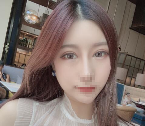 鼻綜合整形手術恢復效果