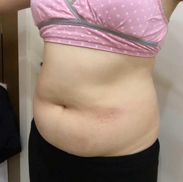 廣州星團醫(yī)學整形醫(yī)生顧鵬做腹部吸脂效果怎么樣?顧鵬腹部吸脂案例展示 廣州星團醫(yī)學整形醫(yī)生顧鵬做腹部吸脂效果怎么樣?顧鵬腹部吸脂案例展示