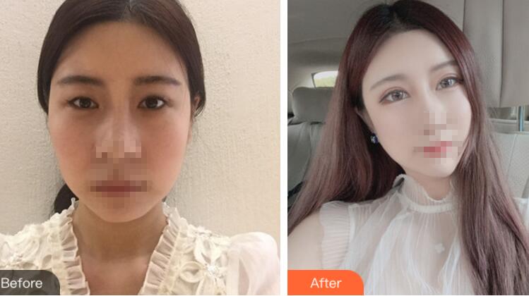 北京彤美整形醫(yī)院專家李長賦做鼻部綜合整形怎么樣?李長賦鼻綜合案例反饋