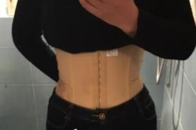 顧鵬腹部吸脂案例展示 顧鵬腹部吸脂案例展示