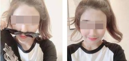 昆明麗都整形醫(yī)生孟春麗做面部自體脂肪填充效果怎么樣？