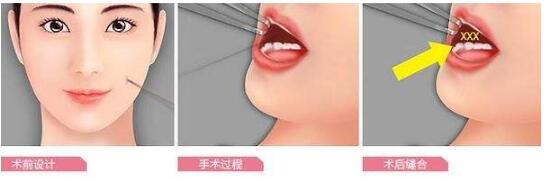 酒窩成形術介紹