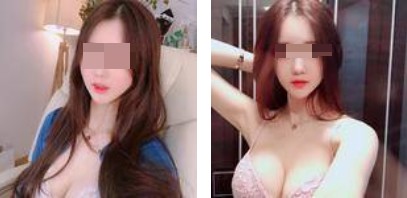 沈陽(yáng)杏林整形美容醫(yī)院崔昌墉醫(yī)生做假體隆胸技術(shù)怎么樣？附案例