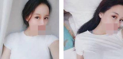 寧波美仁整形美容醫(yī)院李英大醫(yī)生做切開雙眼皮效果怎么樣？