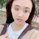 石家莊美然醫(yī)療整形醫(yī)生劉超做激光祛疤效果怎么樣？附劉超醫(yī)生案例