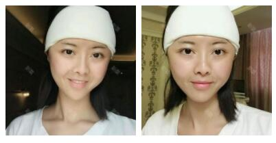 深圳嶺南醫(yī)院整形醫(yī)生丁祖鑫做假體豐太陽穴案例效果對比圖