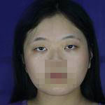 上海亞太醫(yī)療專家周聰做雙眼皮怎么樣？附周聰醫(yī)生雙眼皮案例