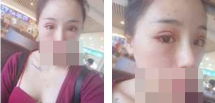 寧波美仁整形美容醫(yī)院李英大醫(yī)生做切開雙眼皮效果怎么樣？