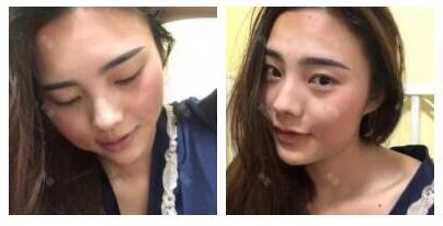 上海首爾麗格整形醫(yī)生魯峰一做自體脂肪全臉填充