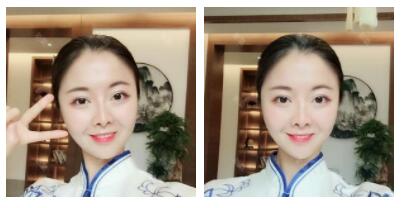 深圳嶺南醫(yī)院整形醫(yī)生丁祖鑫做假體豐太陽穴案例效果對(duì)比圖 深圳嶺南醫(yī)院整形醫(yī)生丁祖鑫做假體豐太陽穴案例效果對(duì)比圖