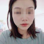 濟南曹博士美容整形醫(yī)院做玻尿酸豐面頰怎么樣？陳正喜醫(yī)生案例