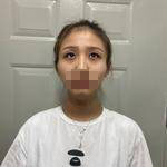 濟(jì)南鵬愛整形醫(yī)生楊力做顴骨顴弓整形技術(shù)怎么樣？楊力醫(yī)生案例展示