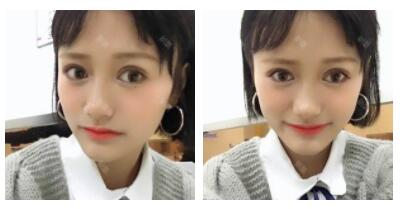 東莞華美做切開雙眼皮怎么樣？朱清武醫(yī)生切開雙眼皮案例分享