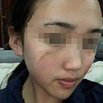 石家莊美然醫(yī)療整形醫(yī)生劉超做激光祛疤效果怎么樣？附劉超醫(yī)生案例