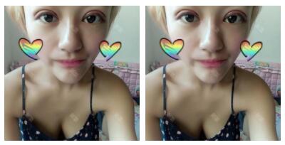 朱清武醫(yī)生切開(kāi)雙眼皮案例分享 朱清武醫(yī)生切開(kāi)雙眼皮案例分享