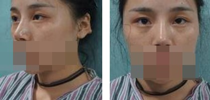 寧波美仁整形美容醫(yī)院李英大醫(yī)生做切開雙眼皮效果怎么樣？