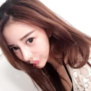 硅膠隆鼻第7天 硅膠隆鼻第7天