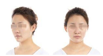 蘭州美月整形美容醫(yī)院文輝才醫(yī)生做鼻綜合整形效果怎么樣？附鼻綜合案例