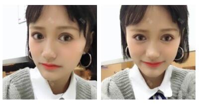 朱清武醫(yī)生切開(kāi)雙眼皮案例分享 朱清武醫(yī)生切開(kāi)雙眼皮案例分享