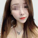 深圳尚虹醫(yī)療整形醫(yī)生藍(lán)劍雄做自體脂肪豐面頰效果怎么樣？附案例