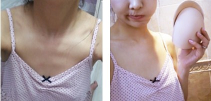 沈陽(yáng)杏林整形美容醫(yī)院崔昌墉醫(yī)生做假體隆胸技術(shù)怎么樣？附案例