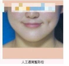 德州市第二人民醫(yī)院燒傷美容整形科張波濤醫(yī)生做酒窩成形術怎么樣？