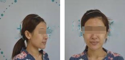 昆明麗都整形醫(yī)生孟春麗做面部自體脂肪填充效果怎么樣? 昆明麗都整形醫(yī)生孟春麗做面部自體脂肪填充效果怎么樣?