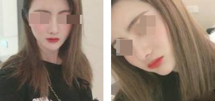 上海新健威醫(yī)療整形醫(yī)生錢成寶做肋軟骨隆鼻+自體脂肪全臉填充案例