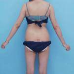 青島銘醫(yī)醫(yī)學(xué)整形醫(yī)生王殿棟做全身吸脂效果怎么樣？附案例展示