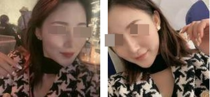 蘭州美月整形美容醫(yī)院文輝才醫(yī)生做鼻綜合整形效果怎么樣？附鼻綜合案例