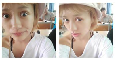 朱清武醫(yī)生切開(kāi)雙眼皮案例分享 朱清武醫(yī)生切開(kāi)雙眼皮案例分享