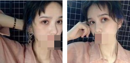 做了切開雙眼皮手術(shù)，才發(fā)現(xiàn)自己原來可以這么美！