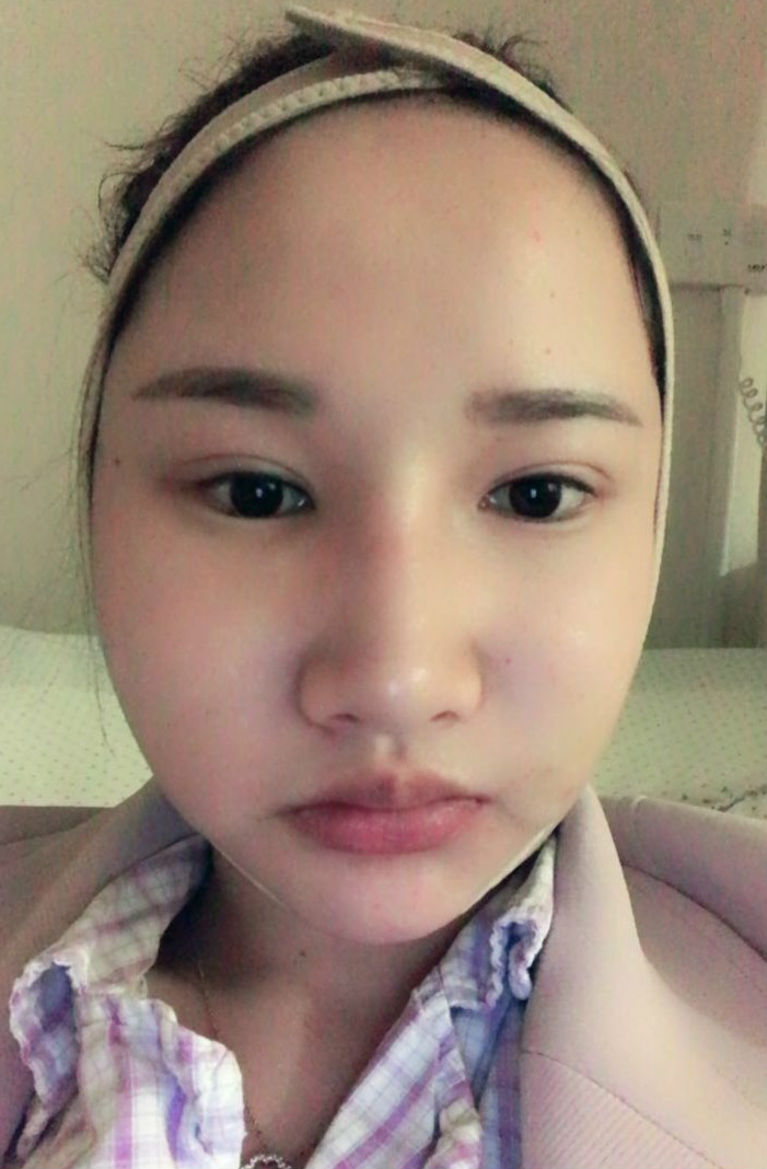 廣州廣大整形醫(yī)生秦瑜做顴骨內推+下頜角整形怎么樣？附案例